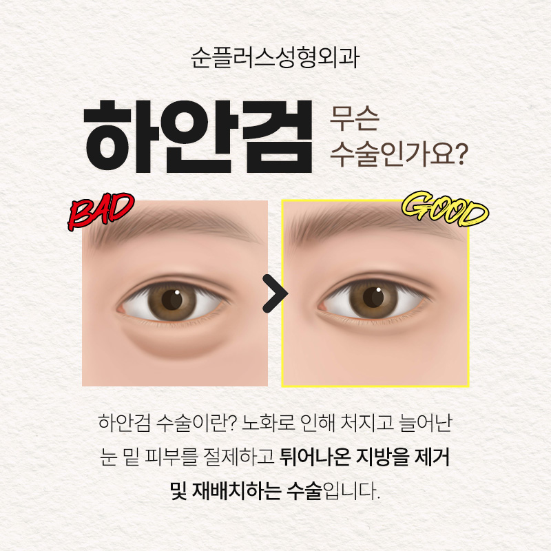 눈밑 하안검수술 회복기간 흉터도 찾아봐야 관련 이미지 2
