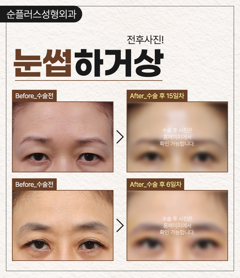 Brow Lift Surgery to Raise Sagging Eyelids and Improve the Eye Shape image 6