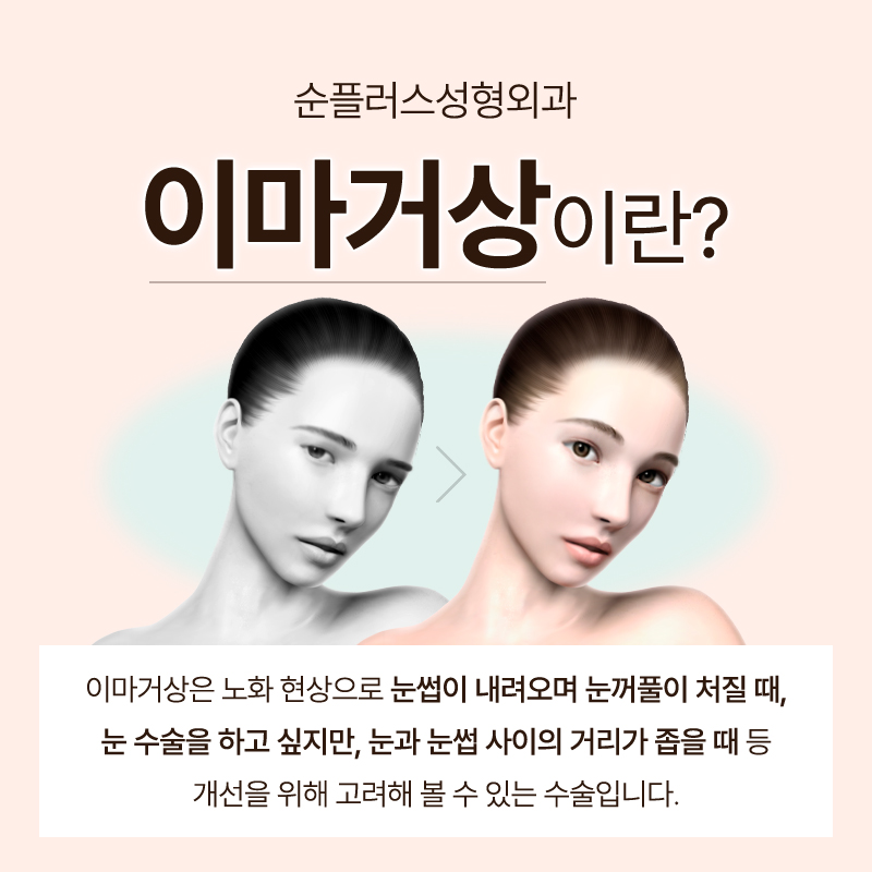 내시경이마거상 이마주름 미간주름 매끈하게 관련 이미지 2