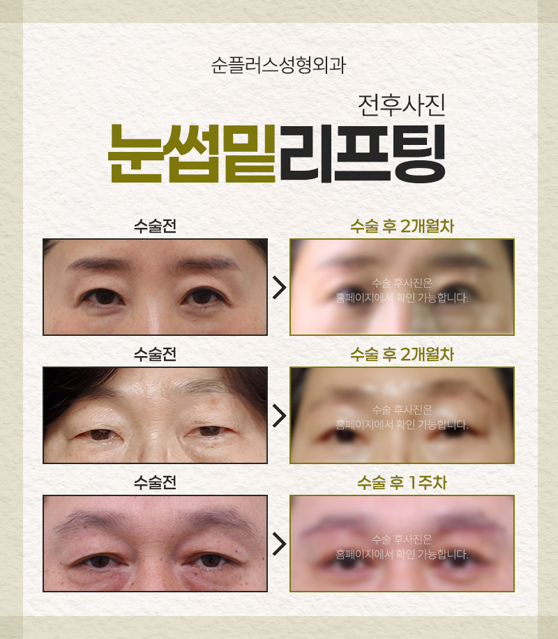 처진 눈꺼풀, 눈썹밑 리프팅 통해 자연스럽게 올려줘 눈매를 또렷하게 관련 이미지 3