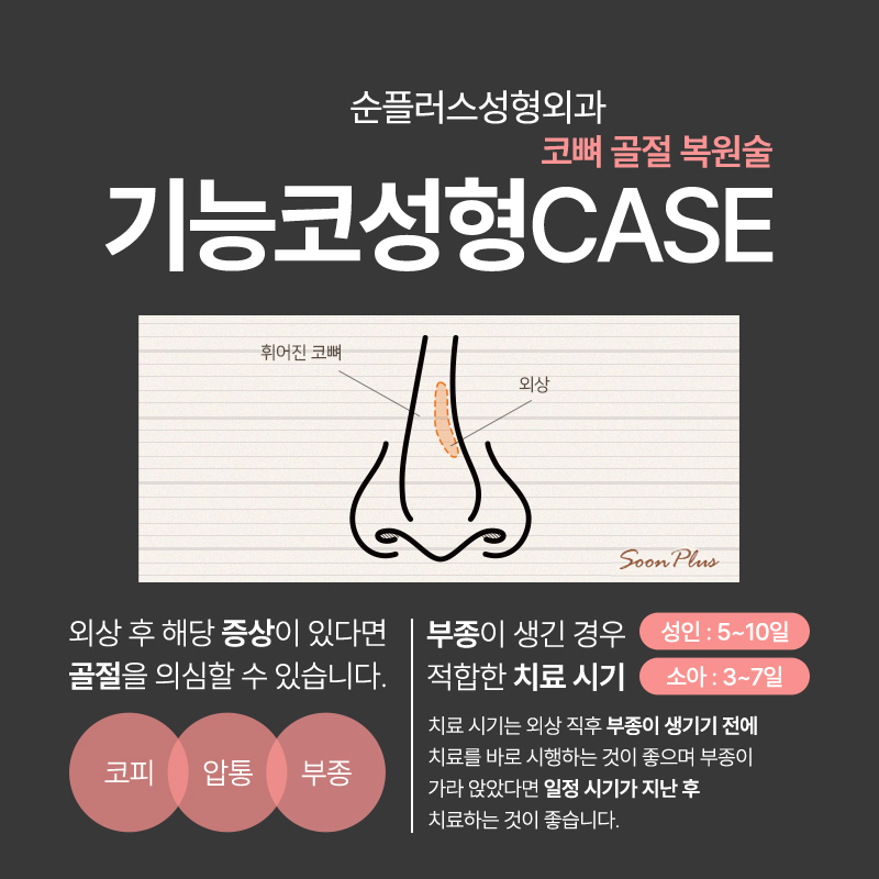 기능코수술 비염 등의 기능적 개선에 콧대 라인까지 관련 이미지 6