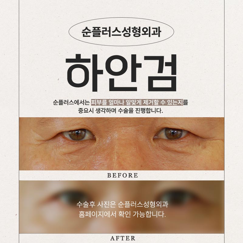 하안검수술잘하는곳 눈밑지방의 유무차이로 관련 이미지 5