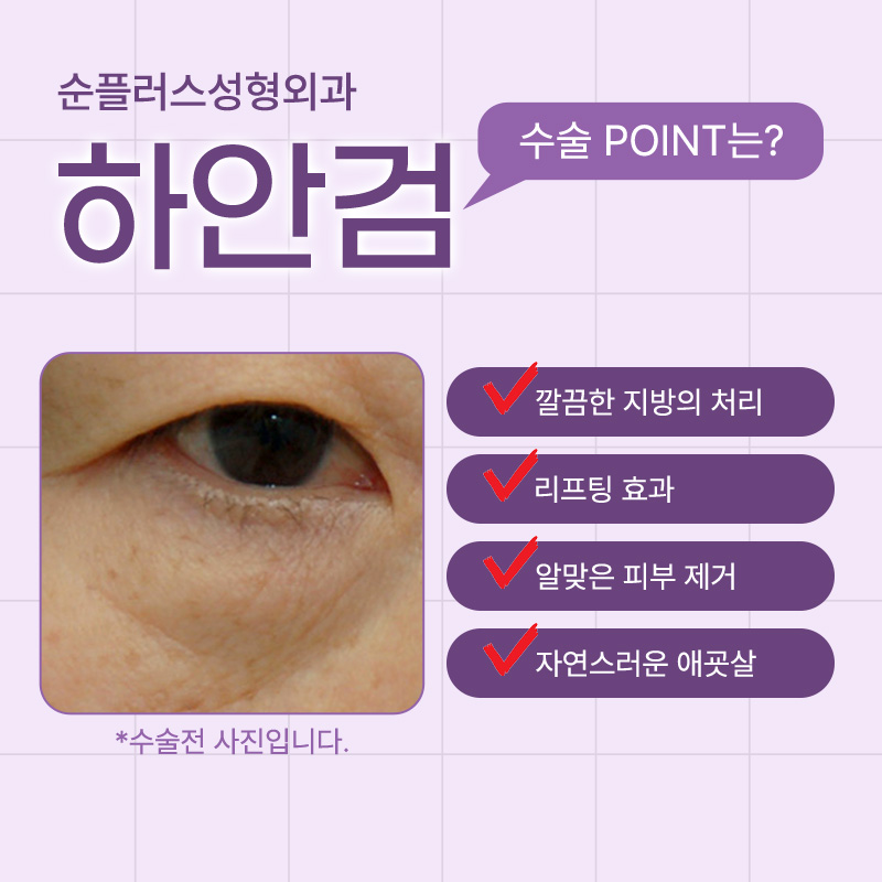 하안검 수술, 눈 밑 노화의 해답일까? 관련 이미지 3