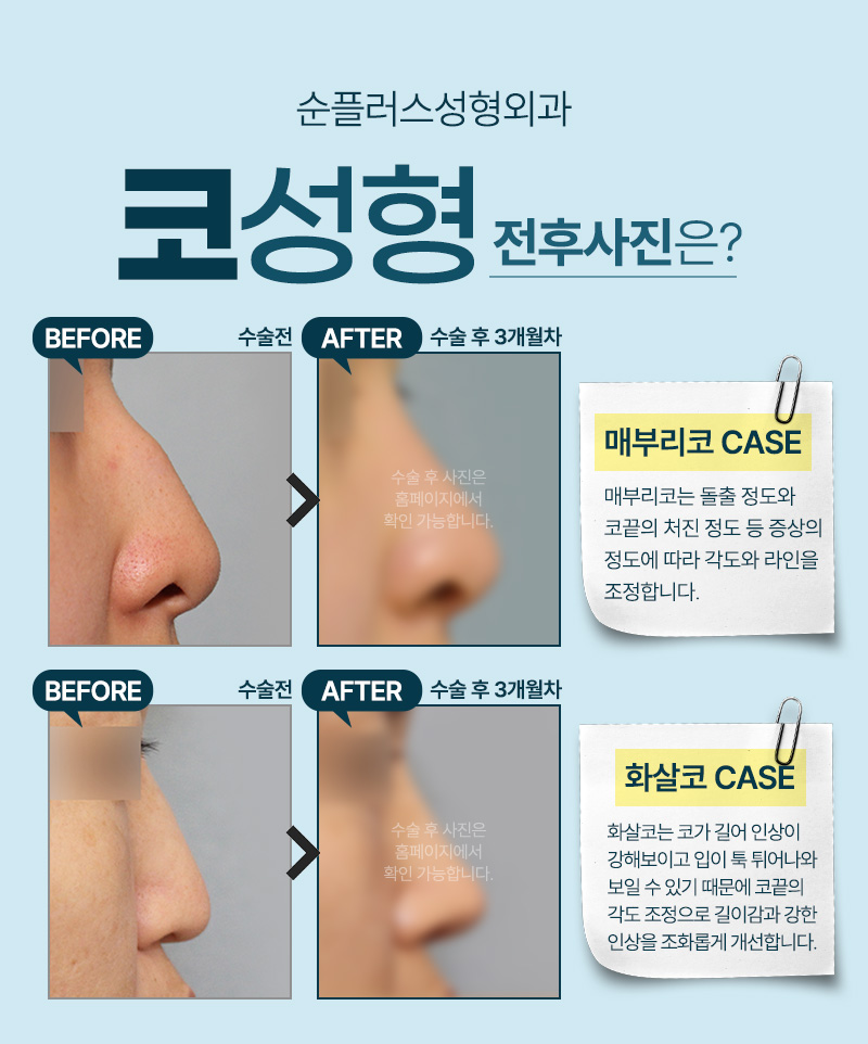 매부리코 화살코 등 유형에 맞는 코수술 플랜으로 관련 이미지 4