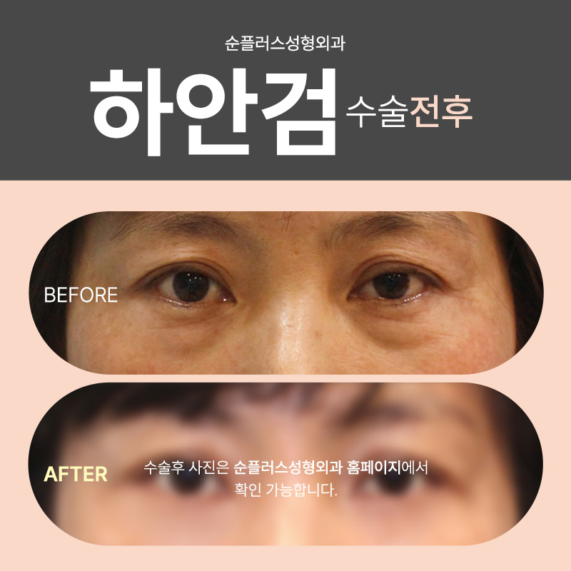 하안검수술비용 주름 지방 동시에 개선을 관련 이미지 5