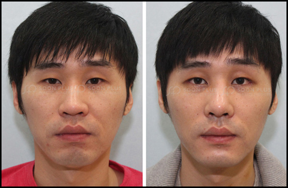 내 눈은 뒤트임 효과를 볼 수 있을까? 눈의 형태에 따라 뒤트임 효과는 달라질 수 있습니다. 관련 이미지 16