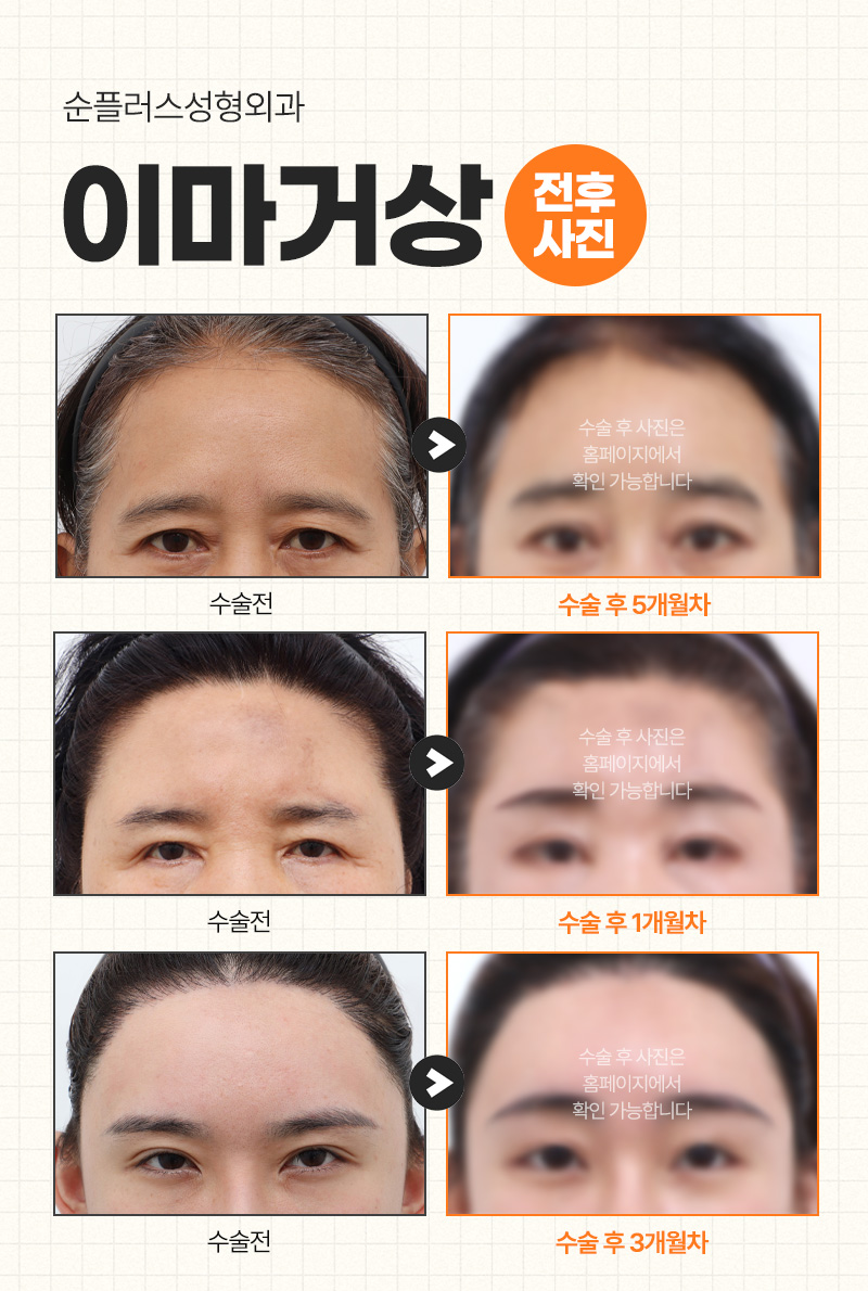 답답한 눈매의 원인, 이마처짐. 내시경 이마거상술로 개선? 관련 이미지 3