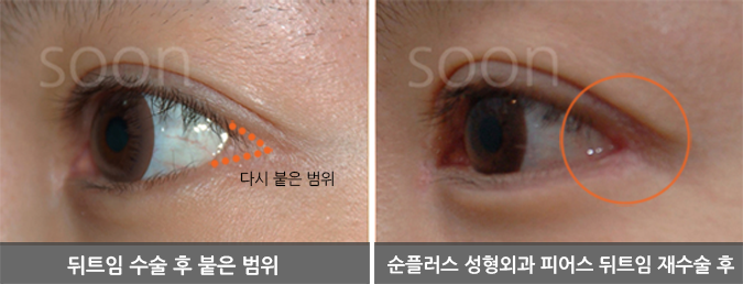 The approach to revision outer corner surgery varies depending on the cause image 8