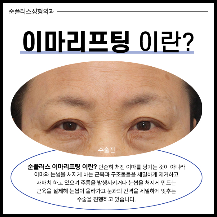 이마리프팅 정교함의 차이로 관련 이미지 2