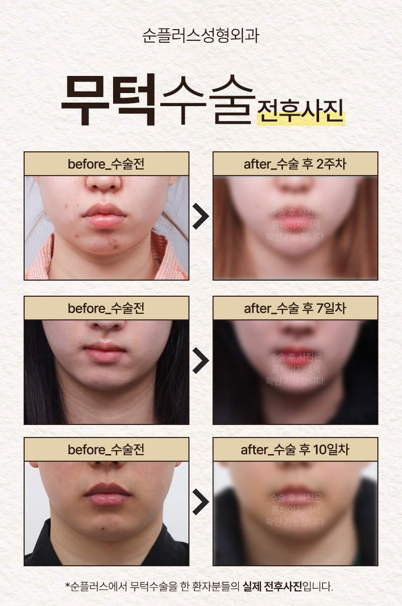 작은턱 짧은턱 변화위해 턱끝수술 고민한다면 관련 이미지 5
