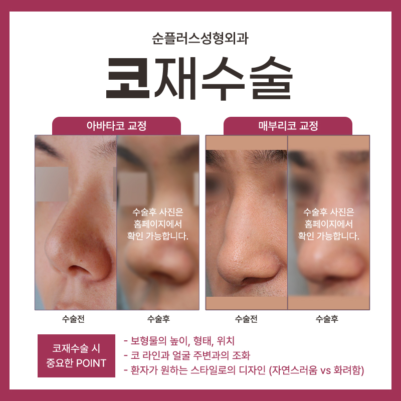 여자코재수술 경험이 많은 곳에서 관련 이미지 4