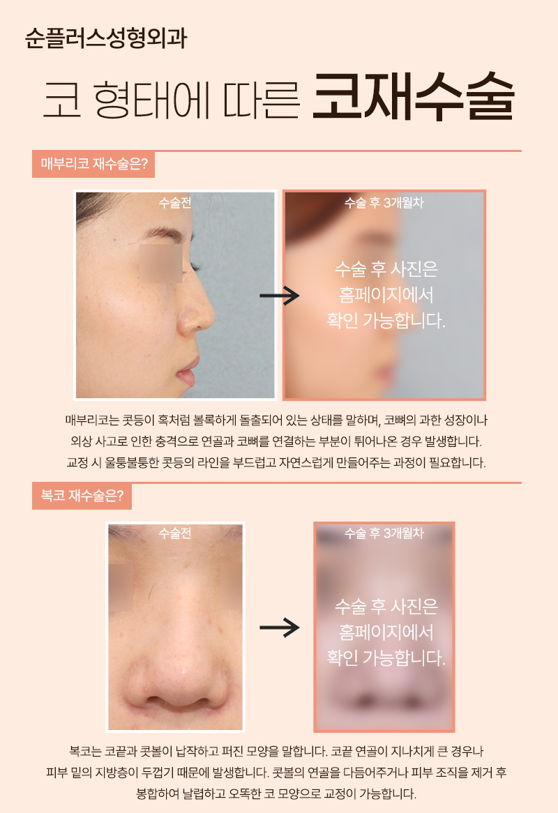 Where to Get Nose Revision Surgery Done Well: Find the Cause and Correct It Properly image 7