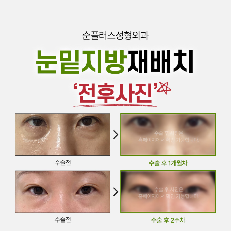 Gangnam Under-Eye Fat Repositioning: A Customized Under-Eye Solution That Improves Hollowing, Puffiness, and Shadowing Under the Eyes. image 6