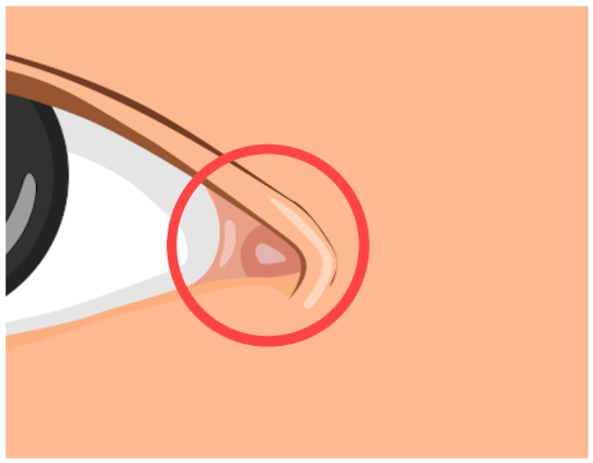 'Am I Really a Candidate for Epicanthoplasty Revision?' Dr. Kim Soondong’s Story About Epicanthoplasty Revision Surgery image 3