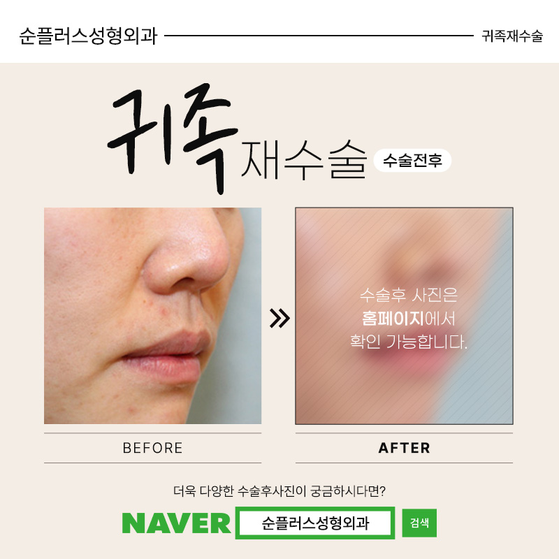 귀족재수술 올바른 위치선정으로 관련 이미지 5