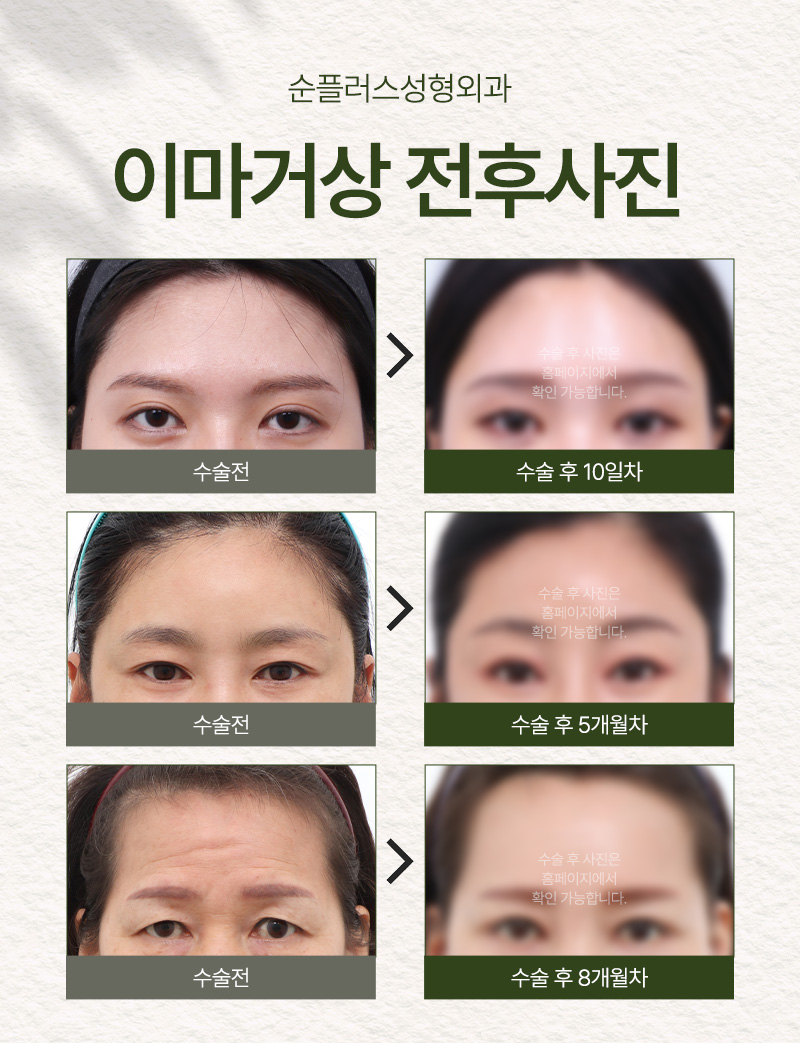 Endoscopic Forehead Lift Surgery: Simultaneously Improving Drooping Eyebrows and Forehead Wrinkles image 3