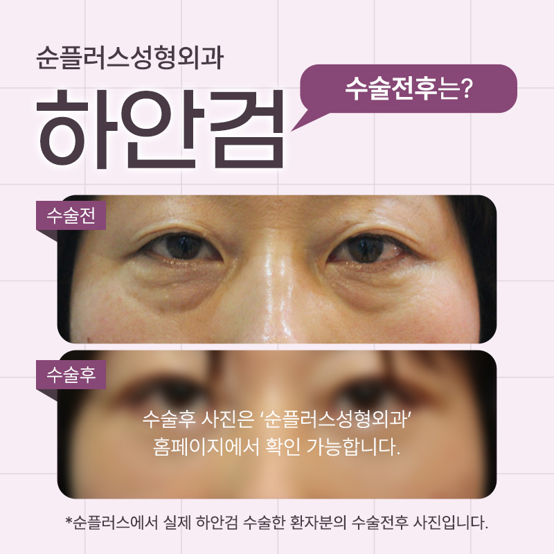 Under-Eye Fat Surgery | Fine lines under the eyes may be caused by fat. image 5