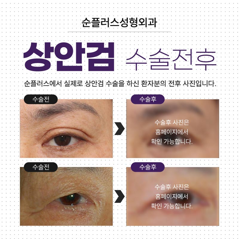 중년쌍꺼풀수술 처짐은 자연스럽게 관련 이미지 6