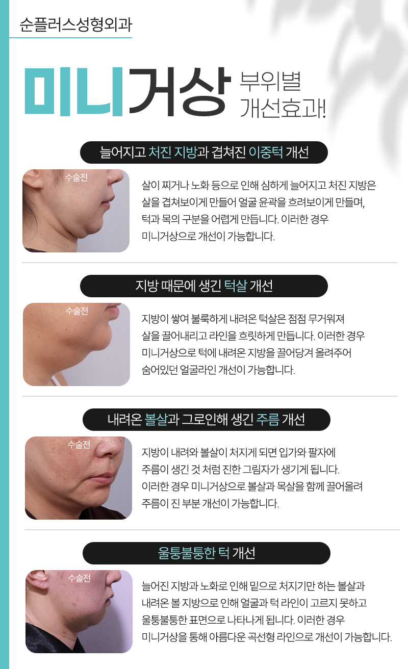 미니거상, 리프팅 효과를 높이기 위한 관련 이미지 4