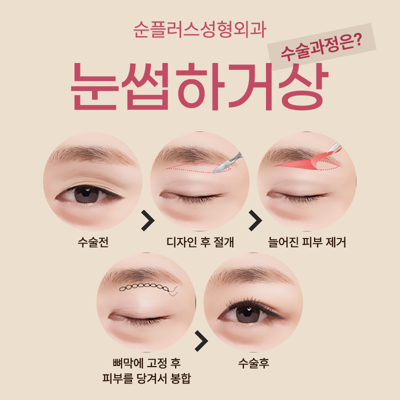 눈썹하거상 흉터 노출 줄이면서 눈은 또렷하게 관련 이미지 3
