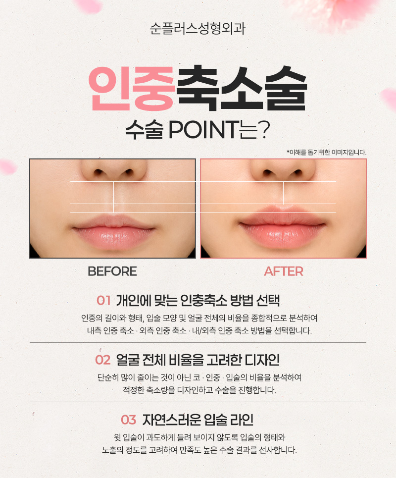 Philtrum Reduction Surgery: Harmonious Proportions Between the Nose and Lips image 3
