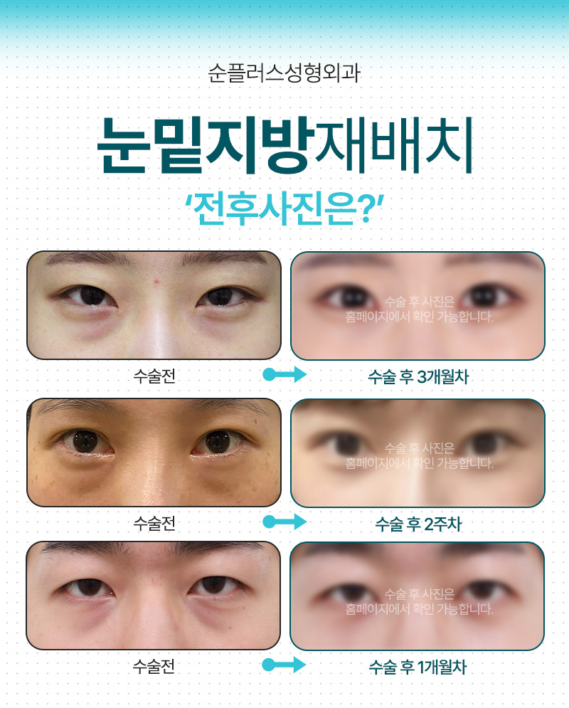 눈밑지방재배치 재수술 예방 위해 격막강화, 이중고정으로 관련 이미지 6
