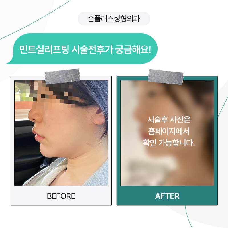 늘어진 턱라인 정리를 위한 민트리프팅 [실리프팅] 관련 이미지 5
