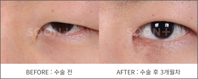 몽고주름으로 답답한 눈매, 부자연스러운 쌍꺼풀라인 개선 위한다면 올바른 앞트임 방법으로 관련 이미지 4