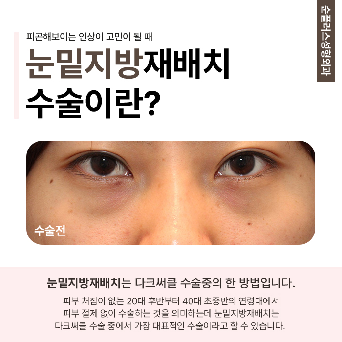 What Makes a Good Under-Eye Fat Repositioning Clinic Different image 2