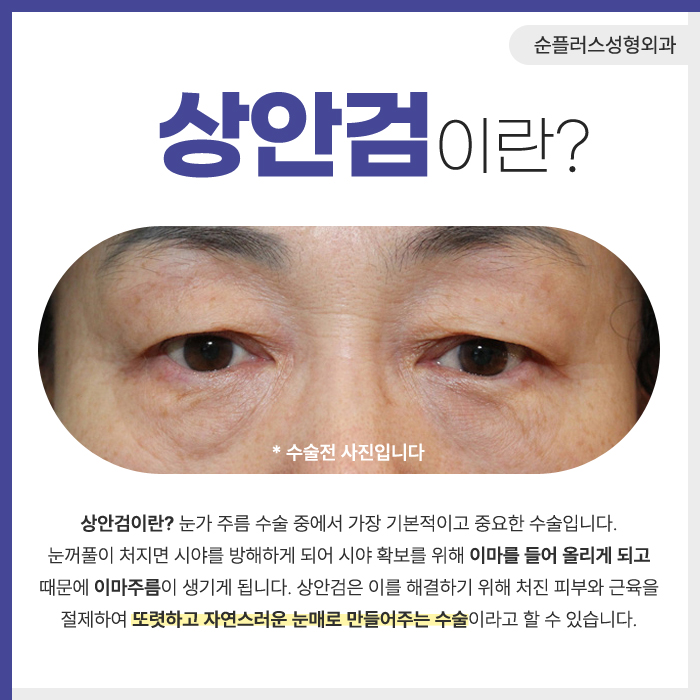 상안검수술 효과 눈꺼풀이 처졌을때 관련 이미지 2