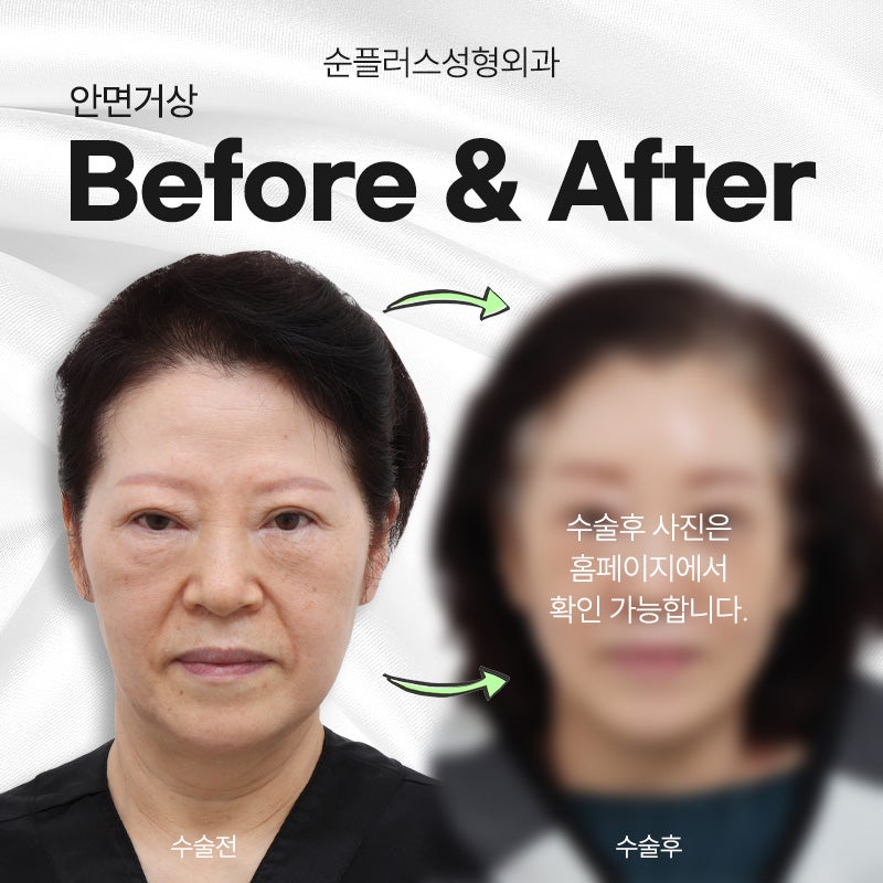 안면거상술잘하는병원 떨어진 탄력을 잡아주고 관련 이미지 6