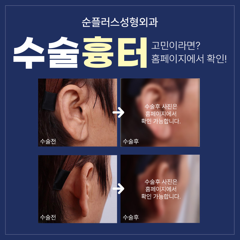 안면거상잘하는곳 핵심 포인트까지 확인 관련 이미지 6