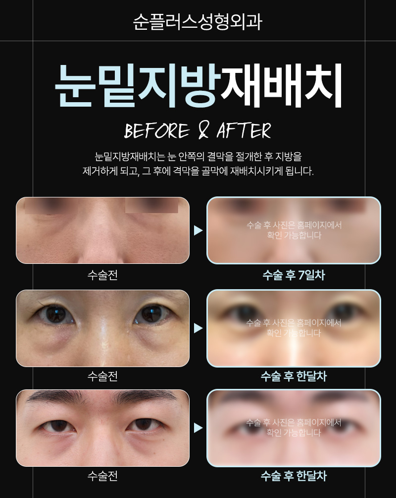 Visiting a Sinsa Station Under-Eye Fat Repositioning Clinic: Detailed Reviews and Reasonable Prices image 4