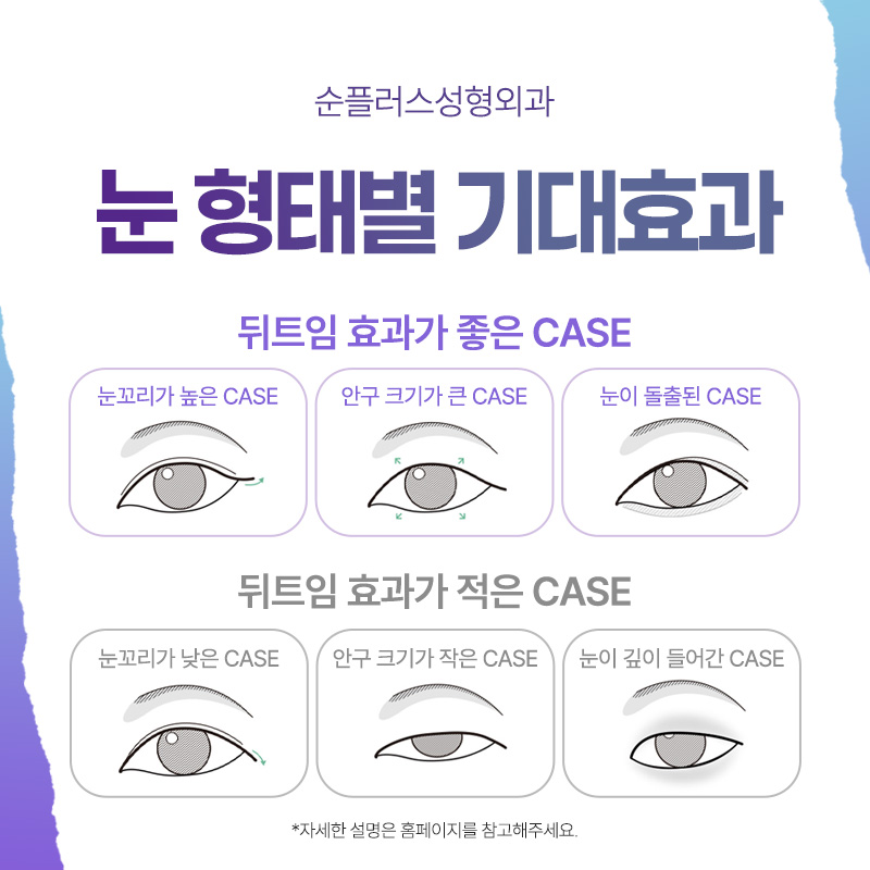 Lateral Canthoplasty (Outer Corner Surgery): Expanding the Horizontal Length While Lowering the Outer Eye Corner for a More Open Look image 6