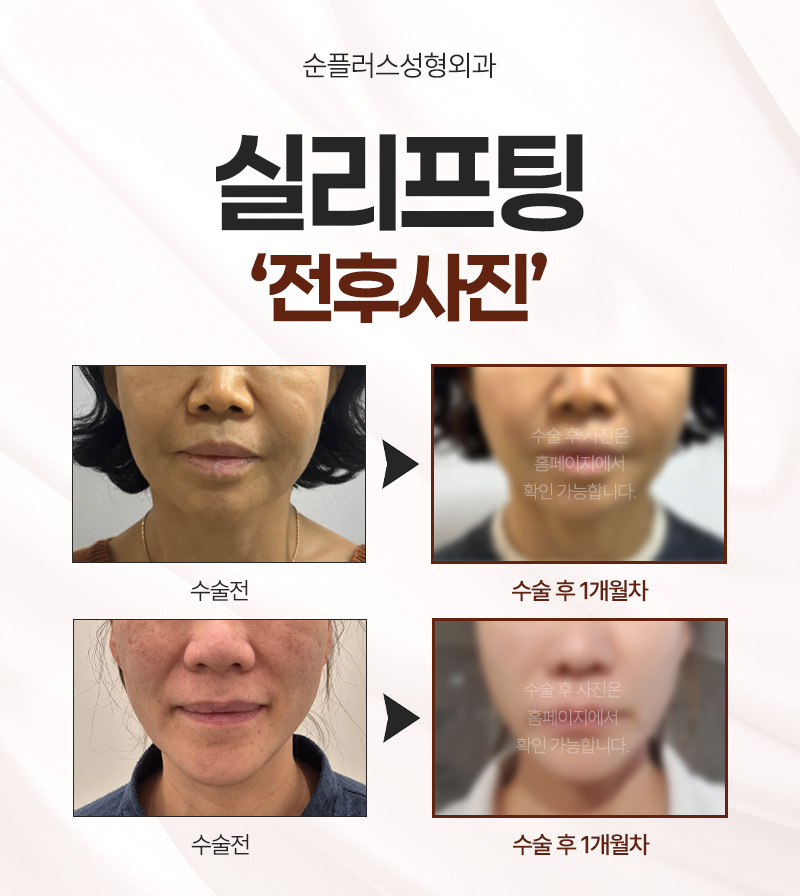 50대 중년 피부 처짐, 수술은 부담된다면 50대 실리프팅 효과를 관련 이미지 5