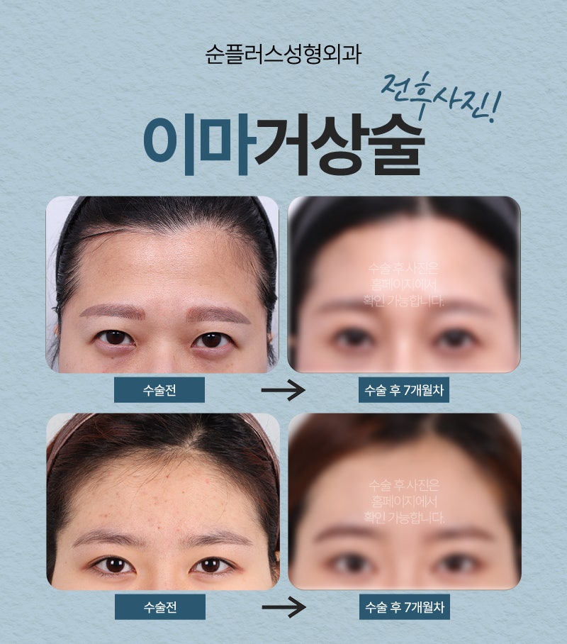 What Are the Effects and Procedure of a Forehead Lift, and Who Needs It? image 6