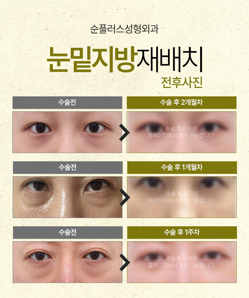 눈밑지방재배치 수술로 칙칙한 다크써클 개선할 수 있나요? 관련 이미지 6
