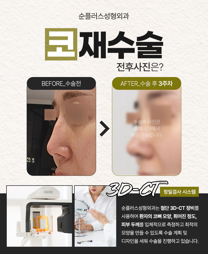 Revision Rhinoplasty Clinic to Avoid a Third or Fourth Surgery image 4