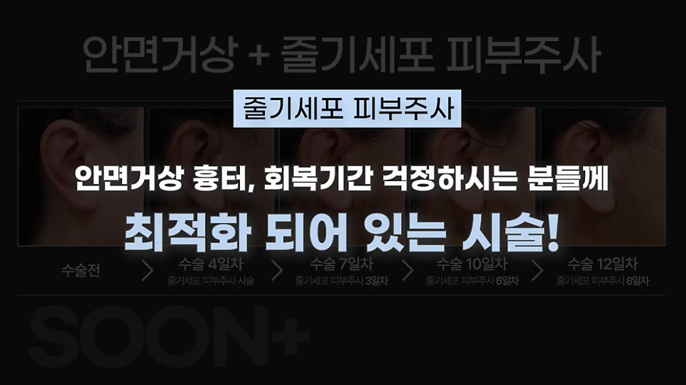 안면거상시 줄기세포주사를 병행하면 어떤 효과를 얻을까 관련 이미지 6