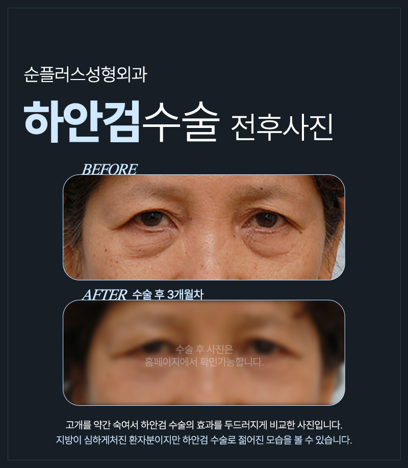 하안검수술잘하는곳 또다시 처지지 않도록 관련 이미지 5