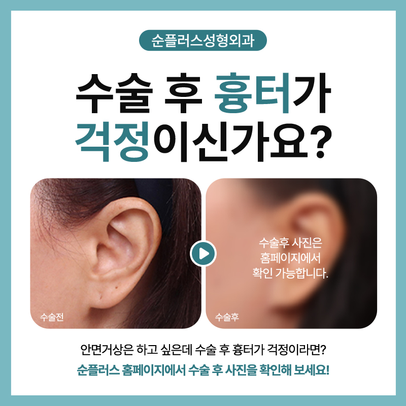The Degree and Direction of Tension at a Clinic That Specializes in Facelifts image 5