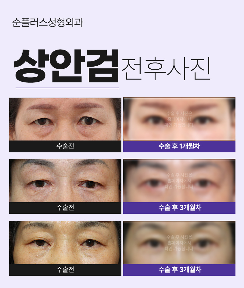 눈처짐으로 인한 중년눈성형 상안검으로 자연스러운 또렷함 추가 관련 이미지 5
