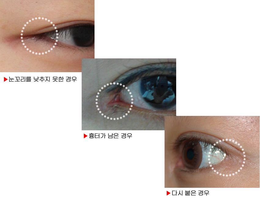The approach to revision outer corner surgery varies depending on the cause image 1
