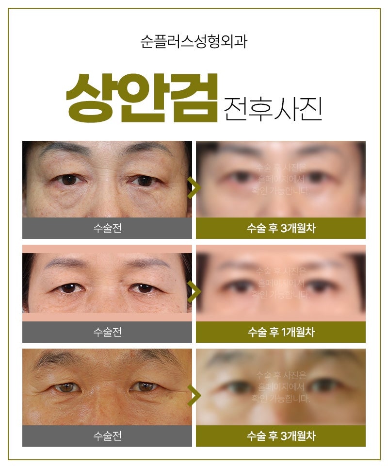 How Long Is the Recovery Period, Including Upper Blepharoplasty Swelling? image 5