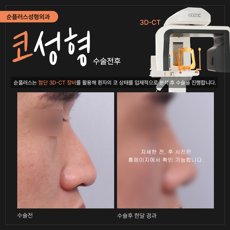 Gangnam Nose Surgery Clinic: Harmony with Surrounding Features Is Important image 5