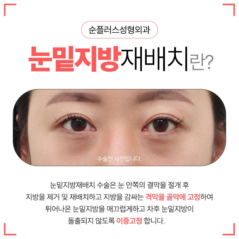 눈밑지방수술 적절한 제거 및 재배치로 눈밑 매끄럽게 관련 이미지 2