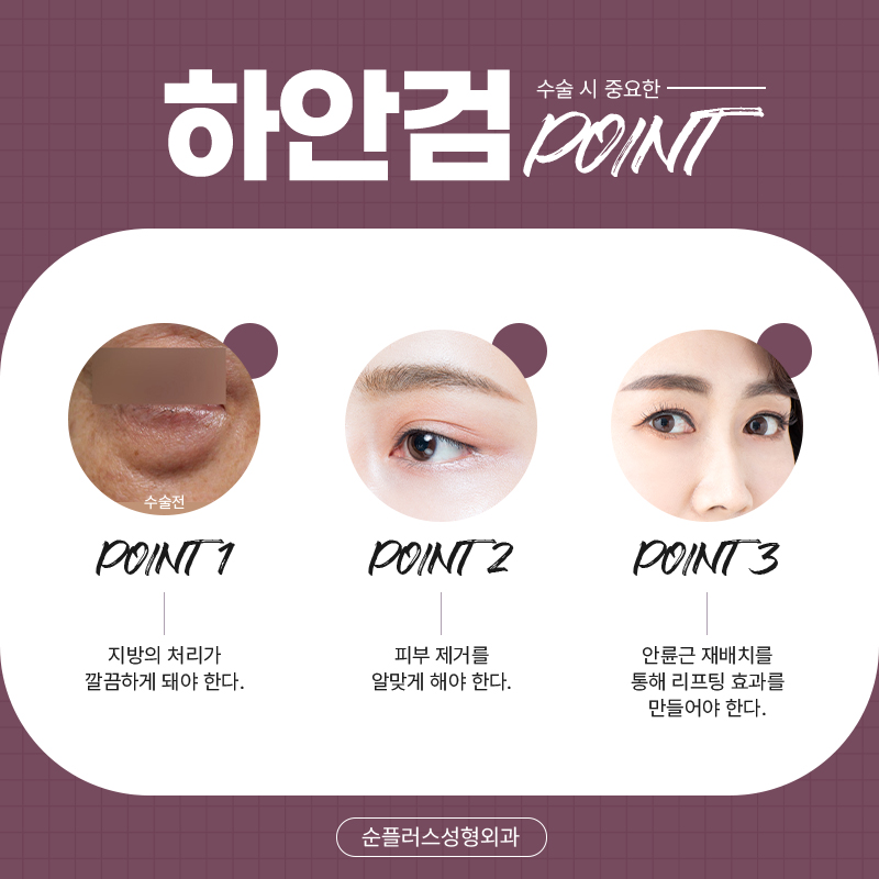 하안검수술잘하는곳 불룩한 눈아래 관련 이미지 4