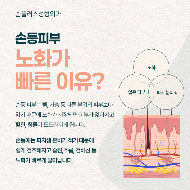 울퉁불퉁 자글자글한 손등 주름, 힘줄, 혈관에 자연스러운 볼륨으로[손등지방이식] 관련 이미지 3