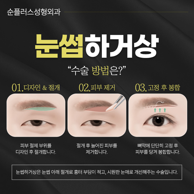 When Aging-Sagging Eyelids Need a Natural Brow Lift [Brow Ptosis Correction] image 5