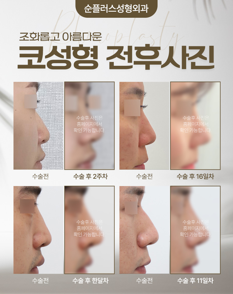 Rhinoplasty Surgery - Improving a Low Nasal Tip and Low Nasal Bridge for a Harmonious Balance image 5